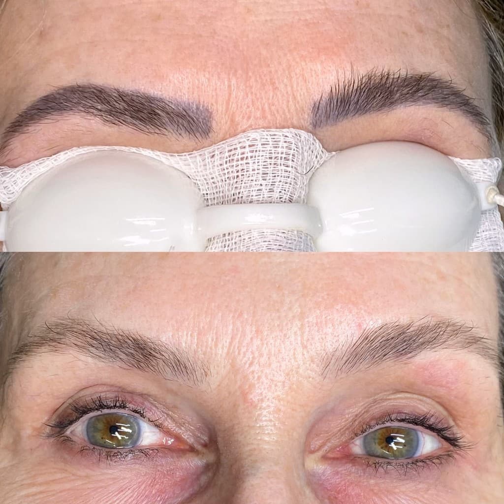 Antes e depois de remoção a laser — caso 1
