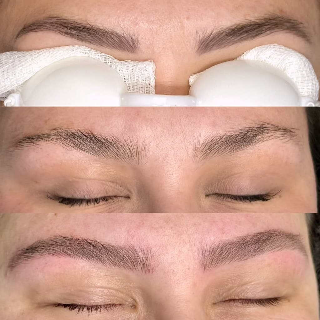 Antes e depois de remoção a laser — caso 3