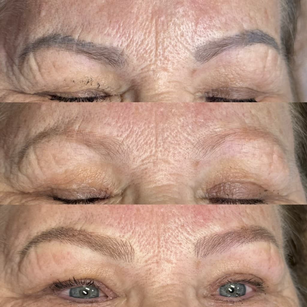 Antes e depois de remoção a laser — caso 4
