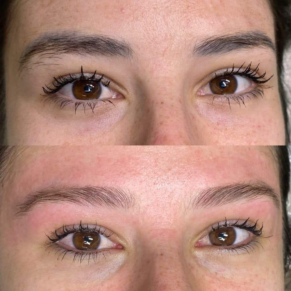 Antes e depois de remoção a laser — caso 5