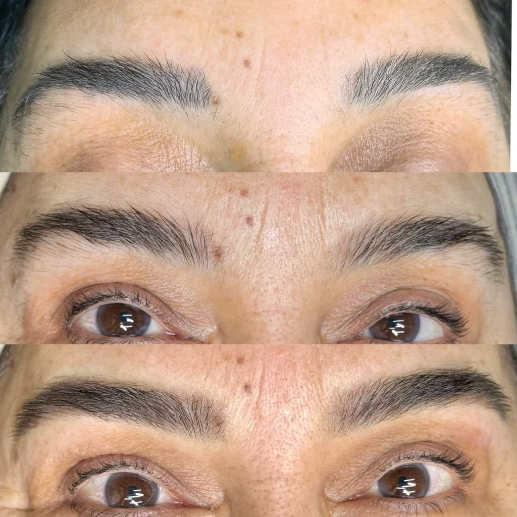 Antes e depois de remoção a laser — caso 6