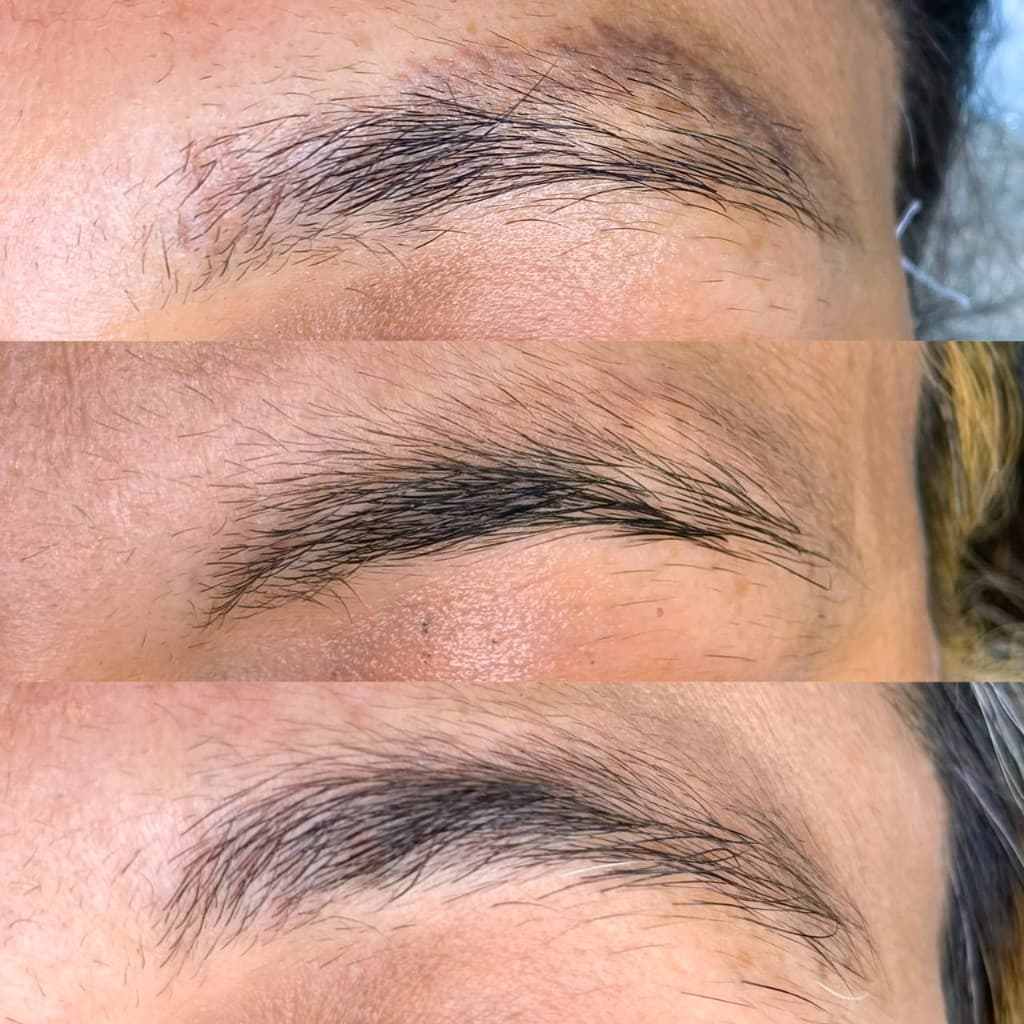 Antes e depois de remoção a laser — caso 7
