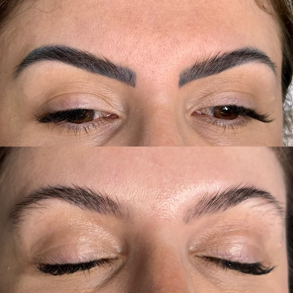 Antes e depois de remoção a laser — caso 8