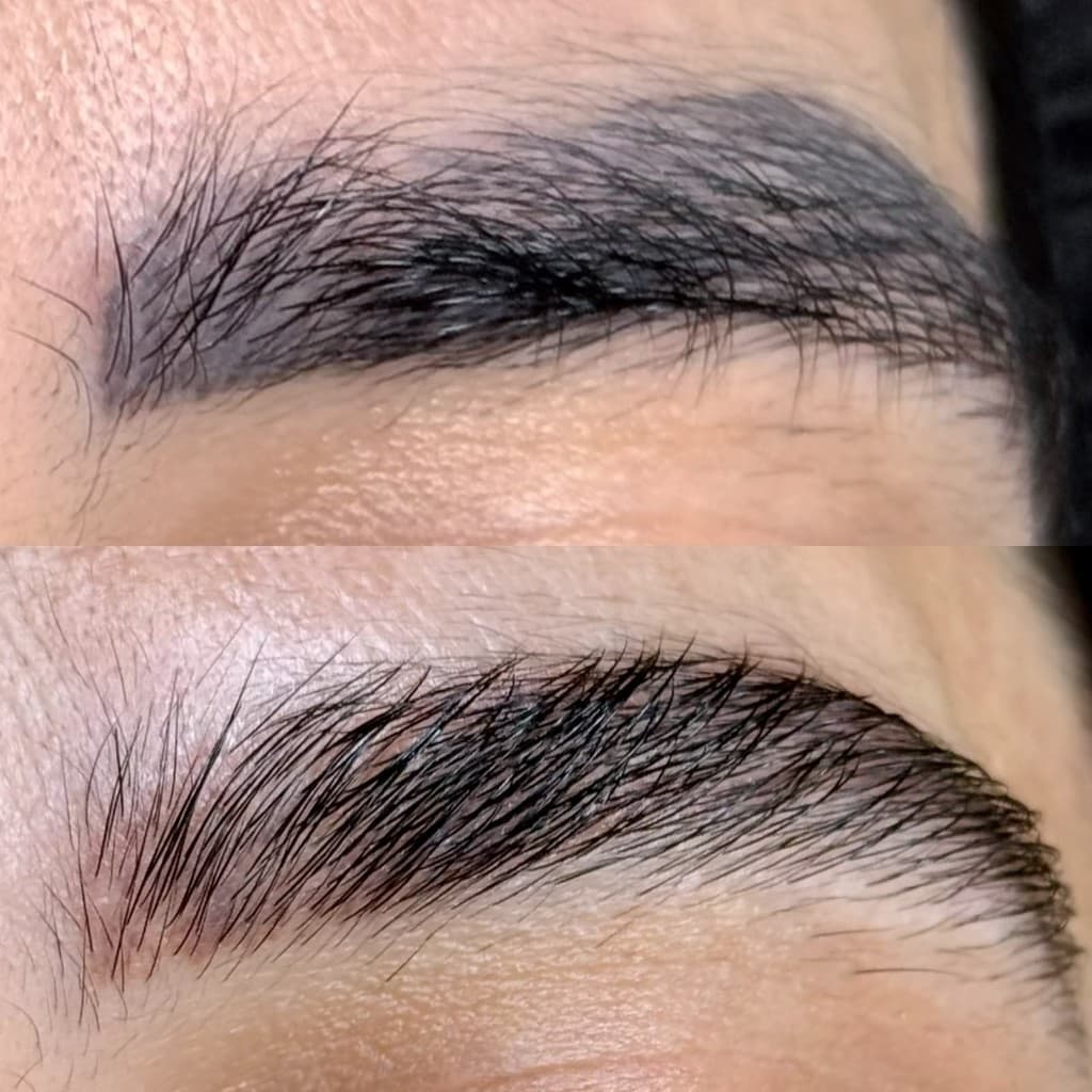 Antes e depois de remoção a laser — caso 9