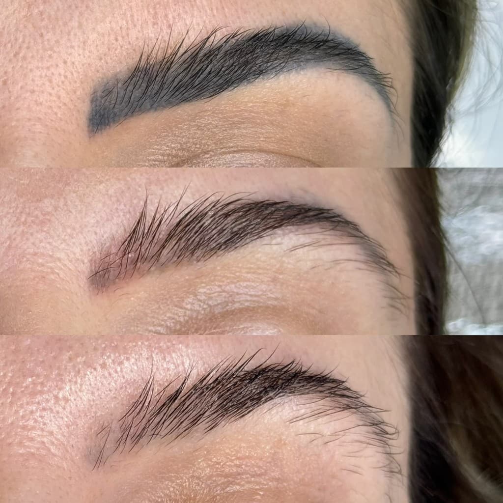 Antes e depois de remoção a laser — caso 10