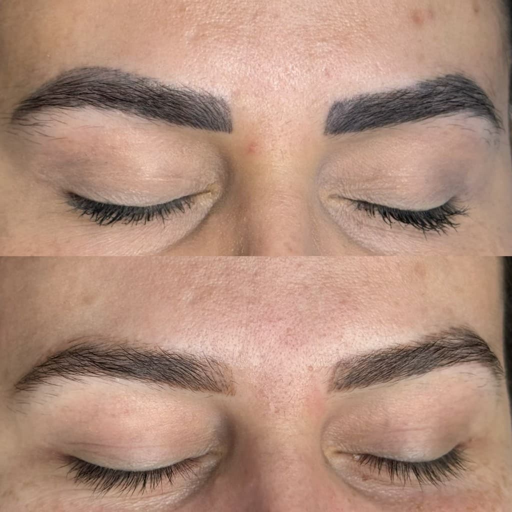 Antes e depois de remoção a laser — caso 11
