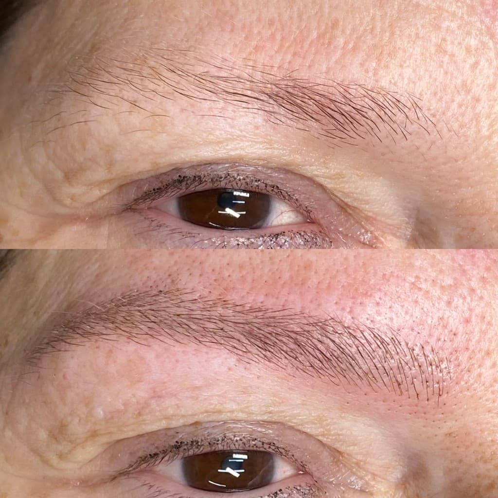 Antes e depois de micropigmentação — caso 1